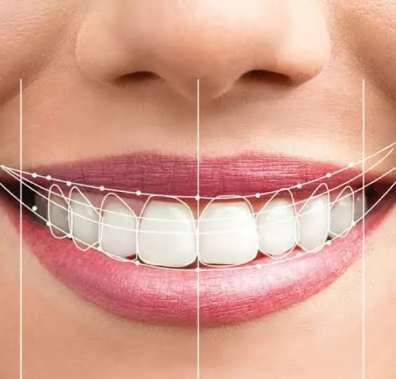 Cosmetic Veneers Before & After